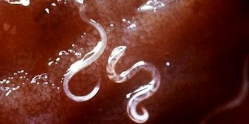 Kancalı kurt hastalığı, belirtileri, tanı ve tedavisi…