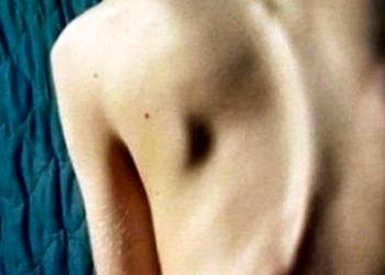 Omurga hastalıkları nasıl tedavi edilir?