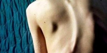 Omurga hastalıkları nasıl tedavi edilir?