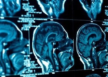 Dirençli depresyonun nedenlerinden biri de beyin tümörü olabilir