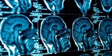 Dirençli depresyonun nedenlerinden biri de beyin tümörü olabilir