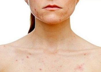 Yetişkinlerde görülen çocuk hastalıkları çok ağır sonuçlar yaratabilir!