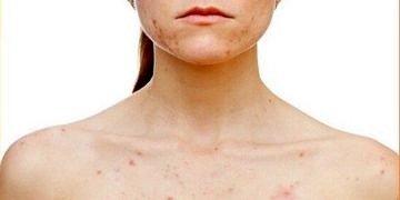 Yetişkinlerde görülen çocuk hastalıkları çok ağır sonuçlar yaratabilir!