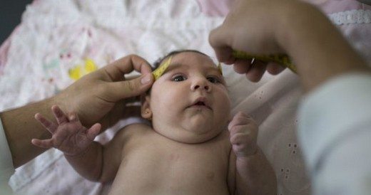 zika virüs bebek
