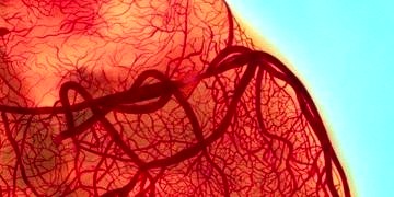 Periferik (Kol ve Bacak) damar tıkanıklıkları tanı ve tedavileri