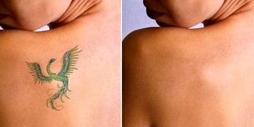 Dövme sildirmek için yeni yöntem; PicoWay