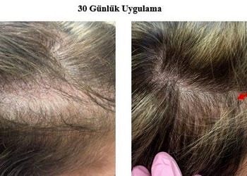 Yeditepe Üniversitesi kelliğe ve saç beyazlamasına çare bulduğunu açıkladı!