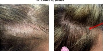 Yeditepe Üniversitesi kelliğe ve saç beyazlamasına çare bulduğunu açıkladı!