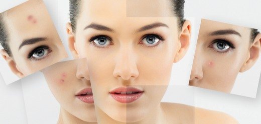 lazer-cilt-lekesi-silme-estetik