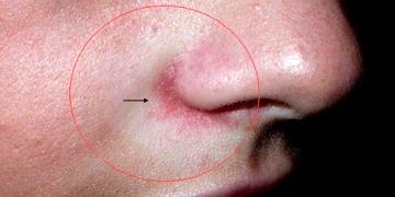 Bahar aylarında gül hastalığına dikkat!