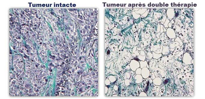 tumor-isik-manyetizma-kanser