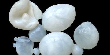 Kist hidatik nedir? Belirtileri ve tedavisi