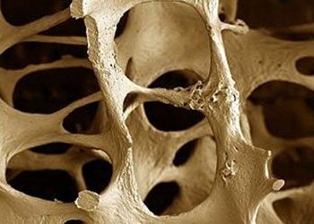 Kemiğimizdeki büyük risk: Osteoporoz nedir? Belirtileri ve tedavisi