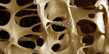 Kemiğimizdeki büyük risk: Osteoporoz nedir? Belirtileri ve tedavisi