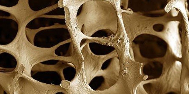 osteoporozlu-kemik
