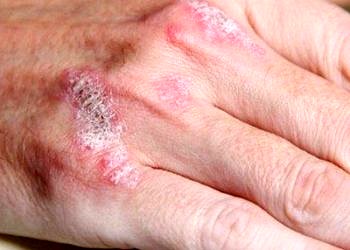 Sedef tedavisinde tama yakın deri iyileşmesi sağlayan yeni bir ilaç