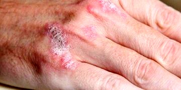 Sedef tedavisinde tama yakın deri iyileşmesi sağlayan yeni bir ilaç