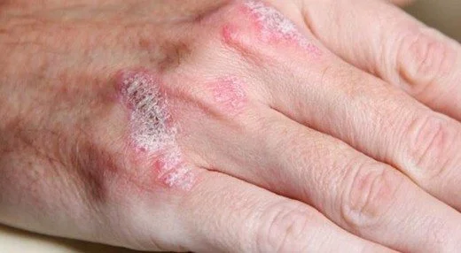 sedef-tedavisi-mumkun