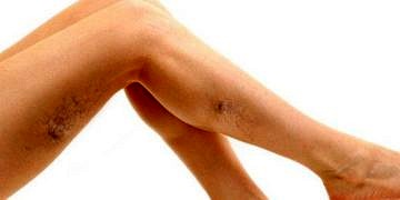 Varis tedavisi ve varisten korunmak için yapılması gerekenler