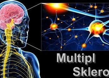 MS (multipl skleroz) hastalığı belirtileri