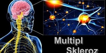 MS (multipl skleroz) hastalığı belirtileri