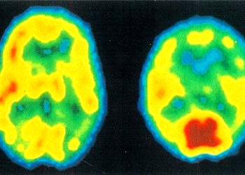 Şizofrenide beynin karar mekanizması bozuluyor