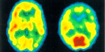 Şizofrenide beynin karar mekanizması bozuluyor