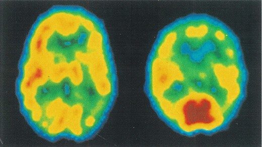 Sol taraftaki görüntülemede sağlıklı kişinin beyninde metabolizma hızının dağılımını görüyorsunuz, eşit ve uyumlu. Sağda şizofren bir kişinin beyninde oksijen ve glikoz tüketiminin nasıl uygunsuz olduğu görülüyor. Koyu kırmızı olarak görüntülenen beyin bölgesi yoğun aktivite gösteriyor. Bu bölge hayal kurma ile ilgili ve beyin bütünlüğünden kopuk çalışıyor. Son Nörogörüntüleme teknikler, (PET) Şizofren kişinin dünyadan kopuk yaşantısının beyinsel karşılığı olarak çarpıcı bilgiler veriyor.