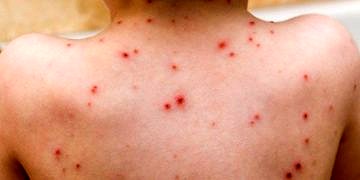 İzmir’de başlayan su çiçeği salgını ölümcül olabilir mi?