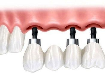 3 boyutlu implant tedavisi ile sabit dişlere kavuşmak mümkün