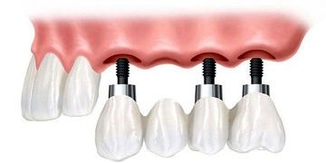 3 boyutlu implant tedavisi ile sabit dişlere kavuşmak mümkün