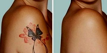 Dövme sildirme hakkında bilmeniz gereken her şey!