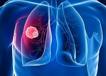 Akciğer kanseri tedavisi: Ameliyat, kemoterapi ve radyoterapi