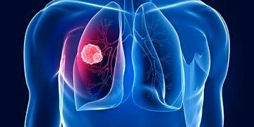 Akciğer kanseri tedavisi: Ameliyat, kemoterapi ve radyoterapi