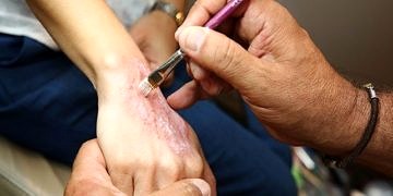 Sedef hastalığı anketi sonuçlandı: Hastalar ayrımcılığa uğruyorlar!