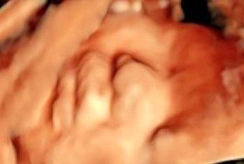 Gebelikte sürecinde bebeklerdeki sakatlık taramaları özenle yapılmalı