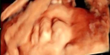 Gebelikte sürecinde bebeklerdeki sakatlık taramaları özenle yapılmalı