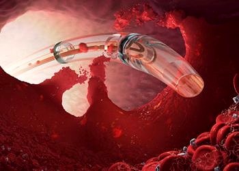 Yeni Kateterle Trombolitik Tedavi ile toplardamar pıhtılaşmasına etkili çözüm