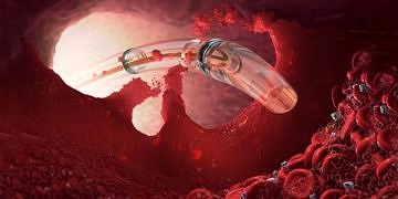 Yeni Kateterle Trombolitik Tedavi ile toplardamar pıhtılaşmasına etkili çözüm