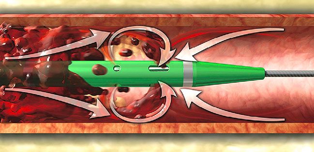 angiojet-stent-damar-emboli