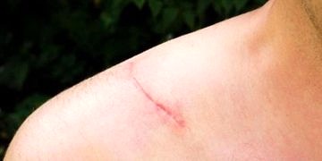 Yara izi kalıcı mıdır? Derideki izleri tedavi etmek mümkün mü?