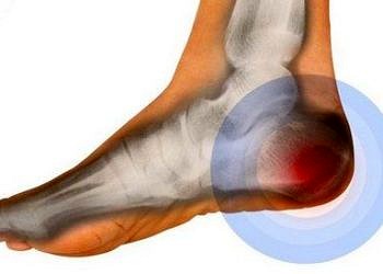 İstirahat sonrası görülen topuk ağrısı ankilozan spondilit habercisi olabilir!