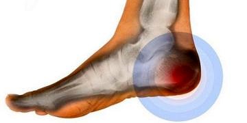 İstirahat sonrası görülen topuk ağrısı ankilozan spondilit habercisi olabilir!