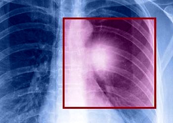 Hedefe yönelik tedaviler ile akciğer kanseri hastalarının umudu arttı