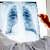 Akciğer grafisi nedir? Nasıl çekilir? Raporu ve sonucu nasıl yorumlanır?