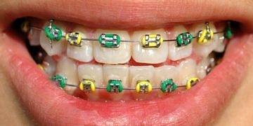 Diş teli tedavisinin yaşı yok