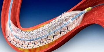 Kalp hastalarının yeni umudu; damar içinde eriyen stent