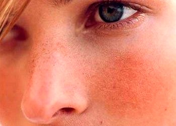 Yüzde şişme ve pembeleşme önemli hastalıkların habercisi olabilir