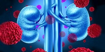 Böbrek kanseri neden olur? Belirtileri ve en etkili tedavi yöntemleri