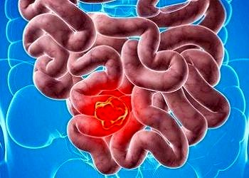 Kalın bağırsak kanserine yol açan 7 önemli etken ve korunma yöntemleri!